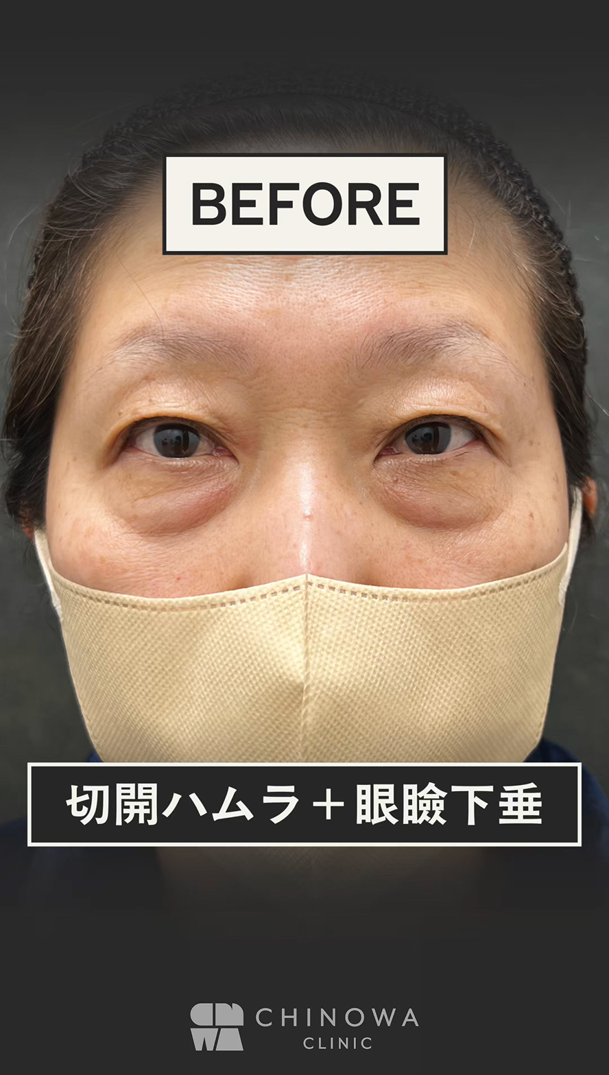 クマ取りといえば則本｜症例件数5000件以上｜CHINOWA CLINIC