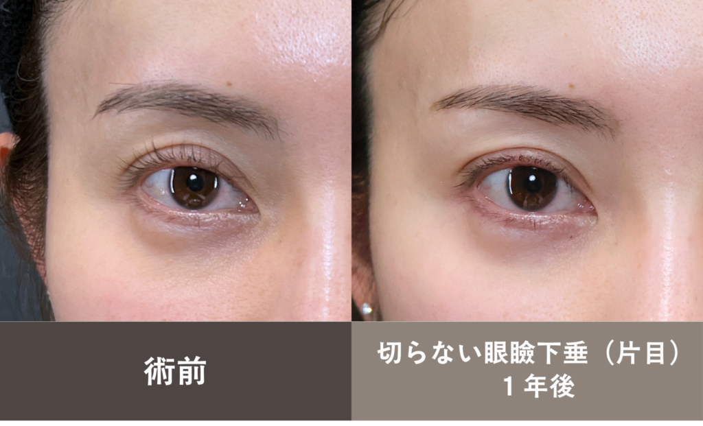 切らない眼瞼下垂の長期経過症例写真（１年後）