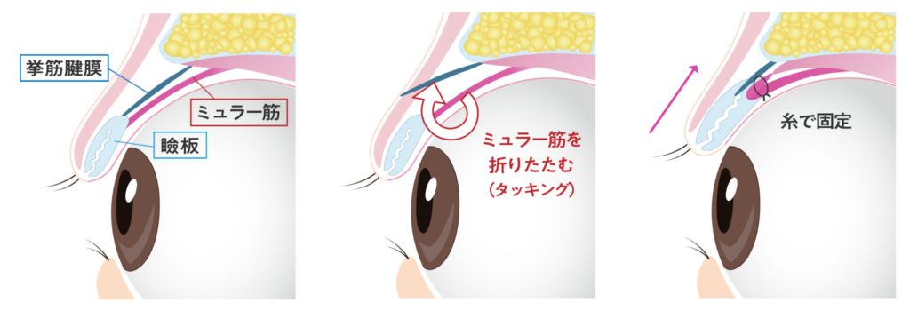切らない眼瞼下垂（MT法）の施術の仕組み