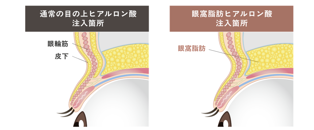 眼窩脂肪ヒアルロン酸注入｜上まぶたのくぼみ・窪み目改善｜原宿・明治