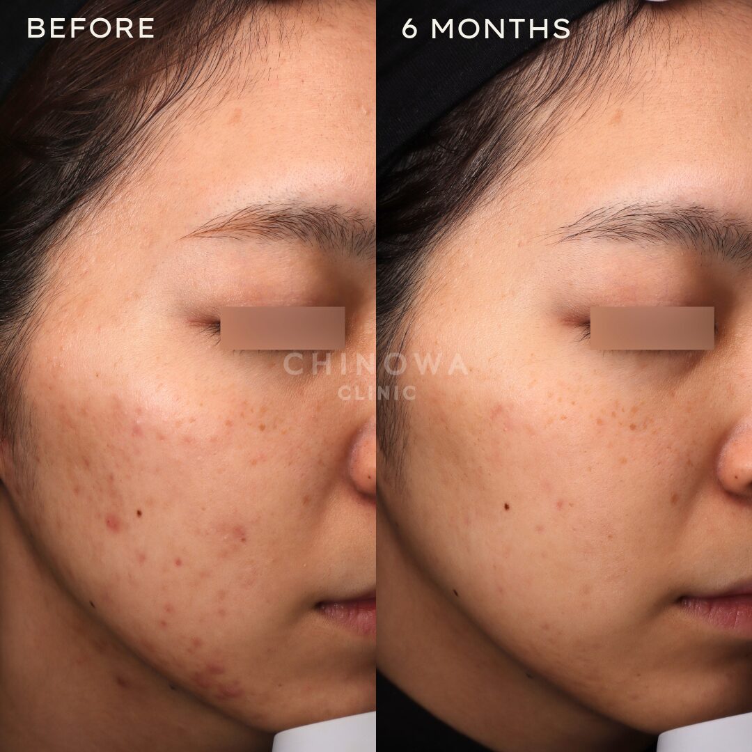 アドバテックスレーザー 5回 No.000036 | CHINOWA CLINIC