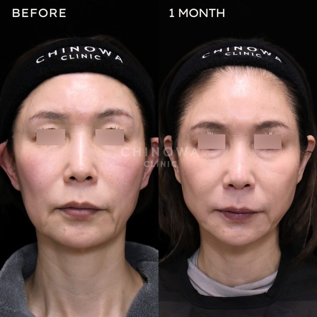 糸リフト＋ぽにょりんで口元のたるみが改善した症例写真
