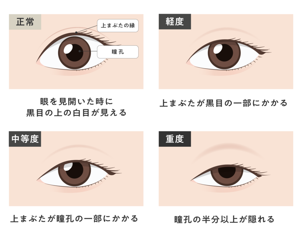 眼瞼下垂の程度