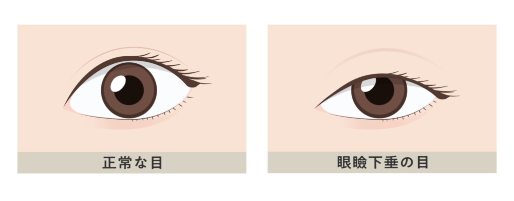 正常な目と眼瞼下垂の目との違い