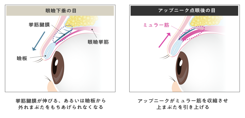 アップニーク点眼後の目