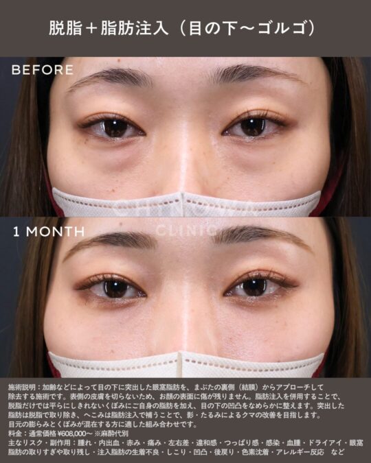 経結膜脱脂と脂肪注入で目の下のクマ・ふくらみ・たるみが改善した症例写真