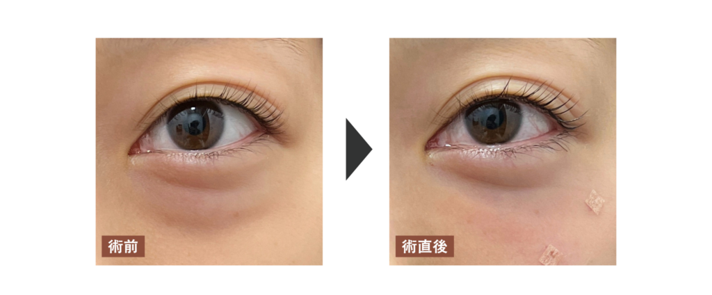 脱脂を受けた患者さまの直後を見ると肌の表面には傷がないことがわかる