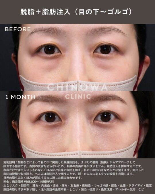 経結膜脱脂と脂肪注入で目の下のクマ・ふくらみ・たるみが改善した症例写真