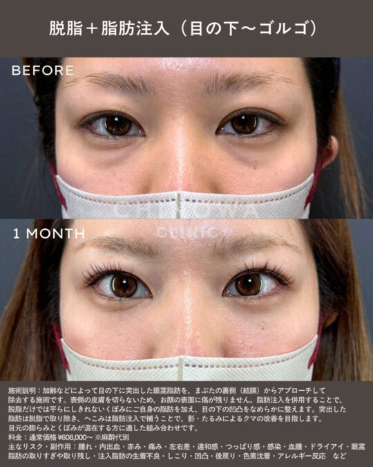 経結膜脱脂と脂肪注入で目の下のクマ・ふくらみ・たるみが改善した症例写真