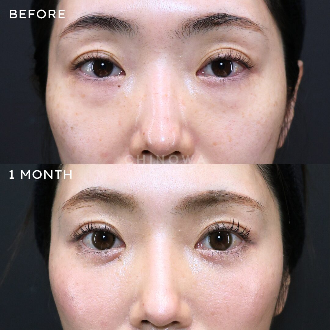 裏ハムラ法＋脂肪注入（目の下～ゴルゴ）＋法令線吊り上げ＋切らない涙袋形成術＋埋没（右目）　　No.000112