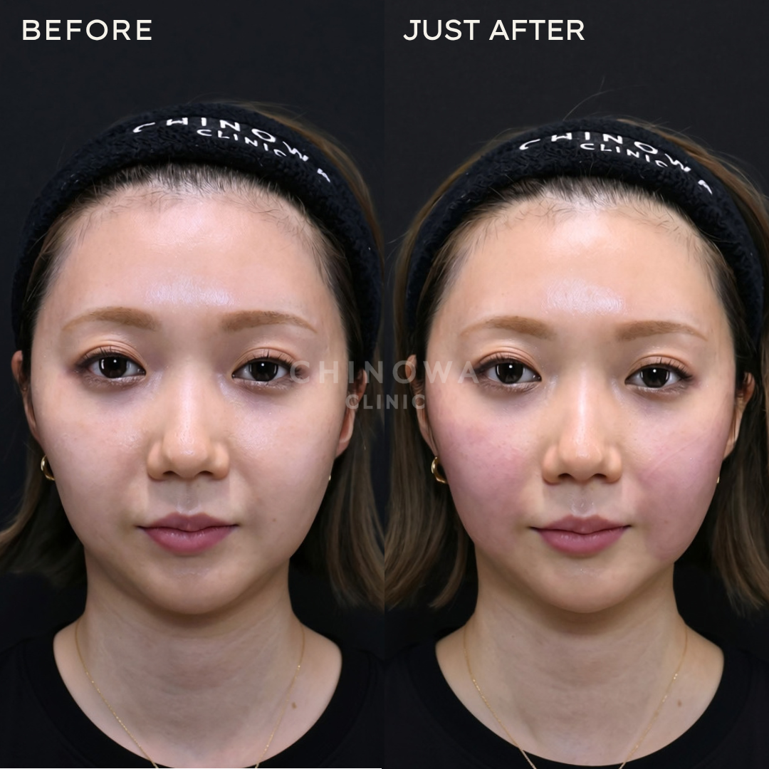 エムフェイス（EMFACE®）｜切らずに表情筋にアプローチ｜ CHINOWA CLINIC