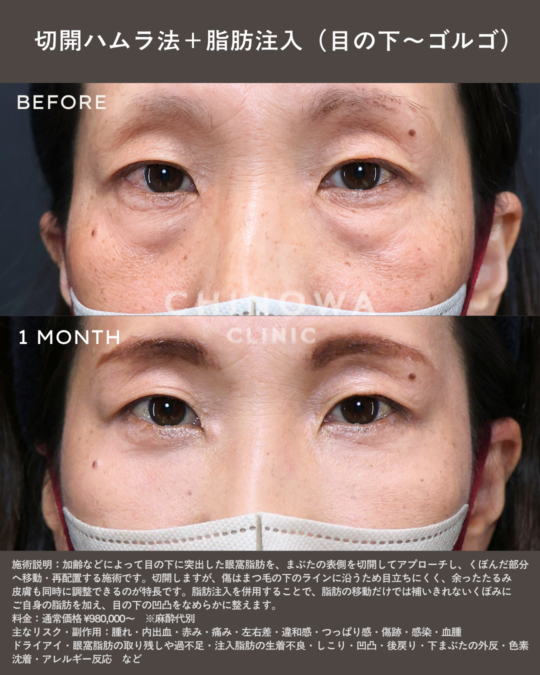 切開ハムラと脂肪注入で目の下のたるみ・ふくらみが改善された症例写真
