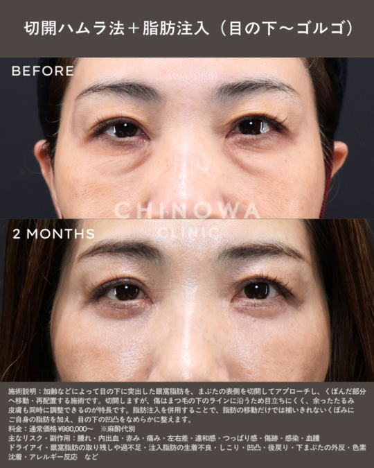 切開ハムラと脂肪注入で目の下のたるみ・ふくらみが改善された症例写真