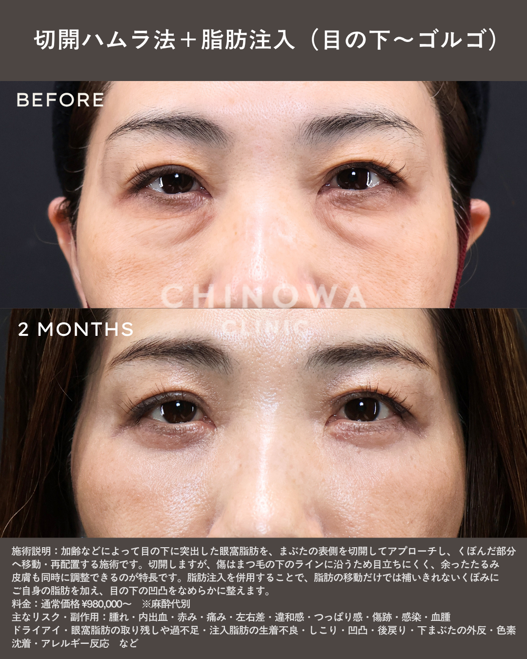 omote-hamura-case03 切開ハムラと脂肪注入で目の下のたるみ・ふくらみが改善された症例写真