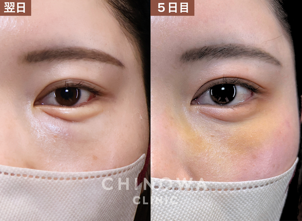 裏ハムラ＋切らない涙袋形成の翌日と・5日目のダウンタイムの様子（内出血が出たケース）