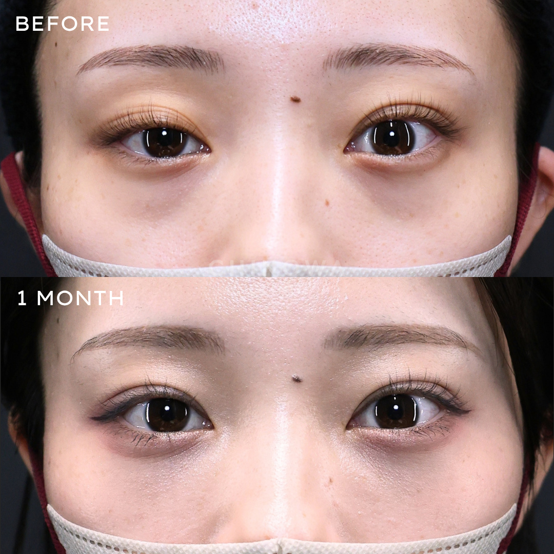 眼瞼下垂（切開法）＋全切開二重術＋裏ハムラ法＋脂肪注入（目の下～ゴルゴ）　　No.000002
