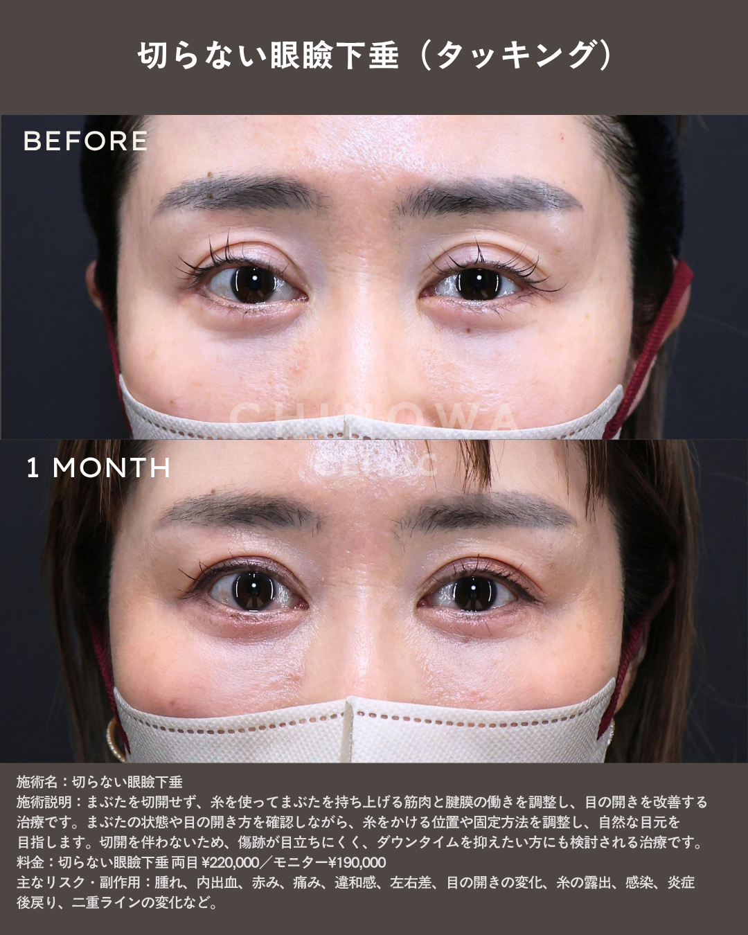 切らない眼瞼下垂（タッキング）の症例写真