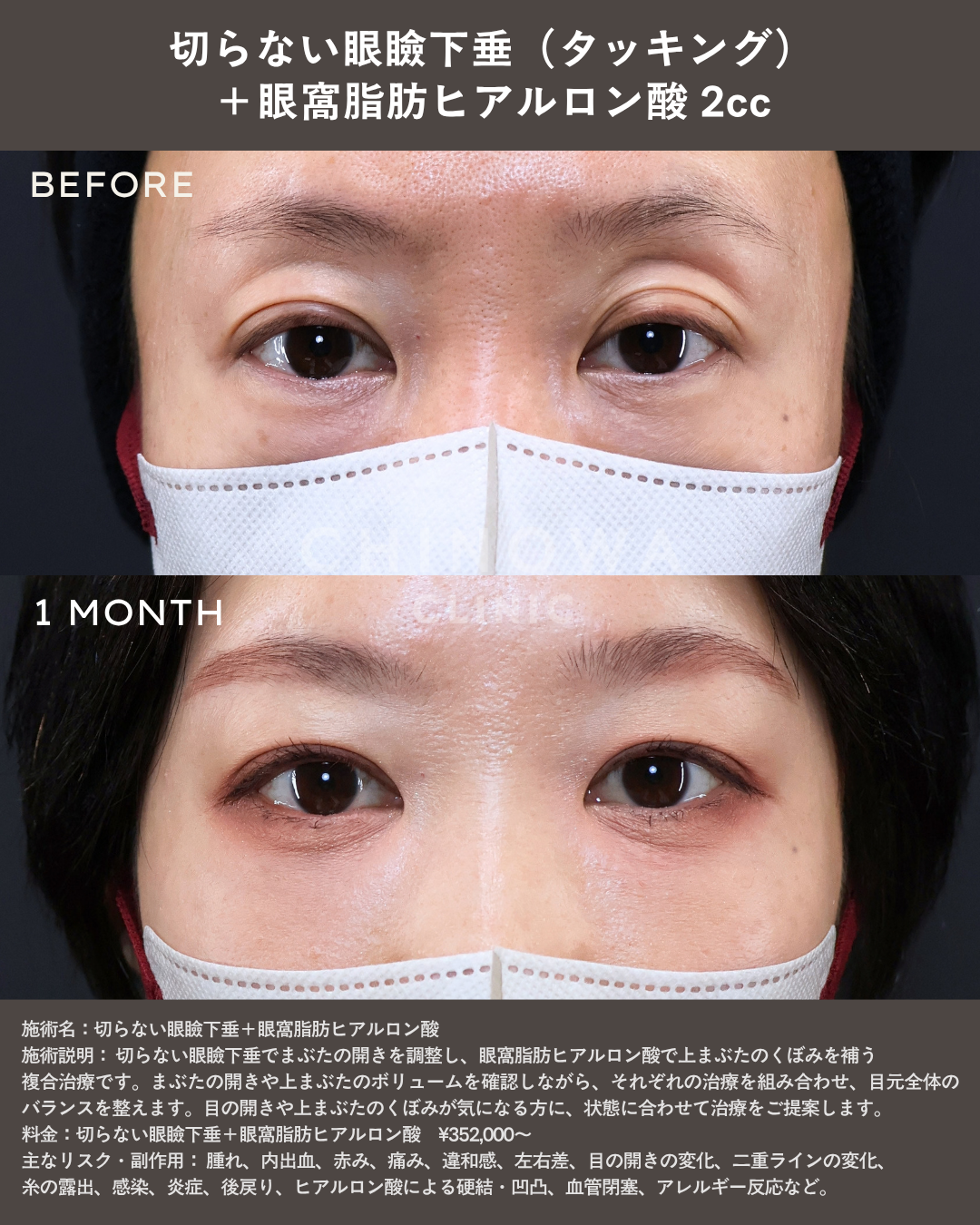 切らない眼瞼下垂（タッキング）の症例写真